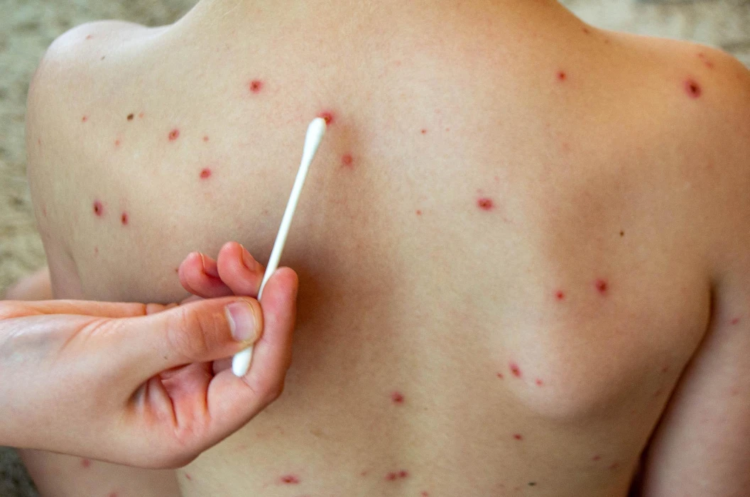 Measles Image